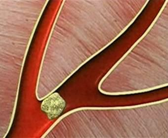 自我检查脑栓塞前兆的妙点