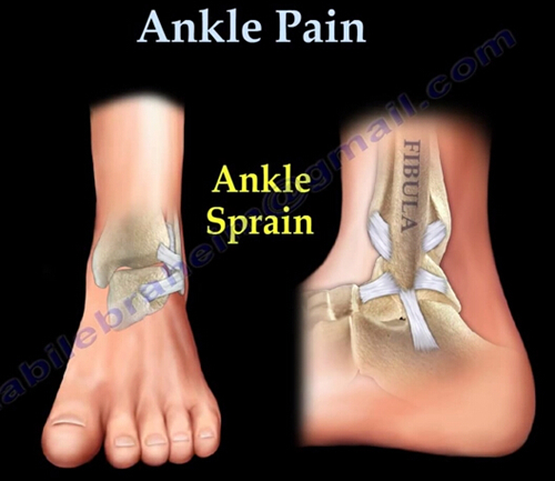 踝关节疼痛，踝关节韧带扭伤