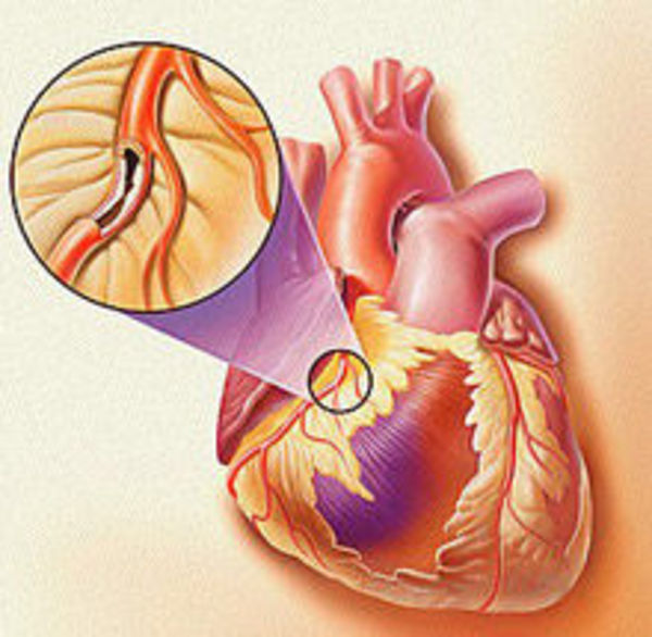 医学动画：急性冠脉综合征和心脏病发作