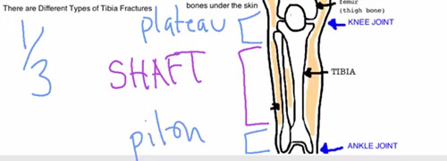 骨科讲座-腿部骨折（胫骨干骨折）