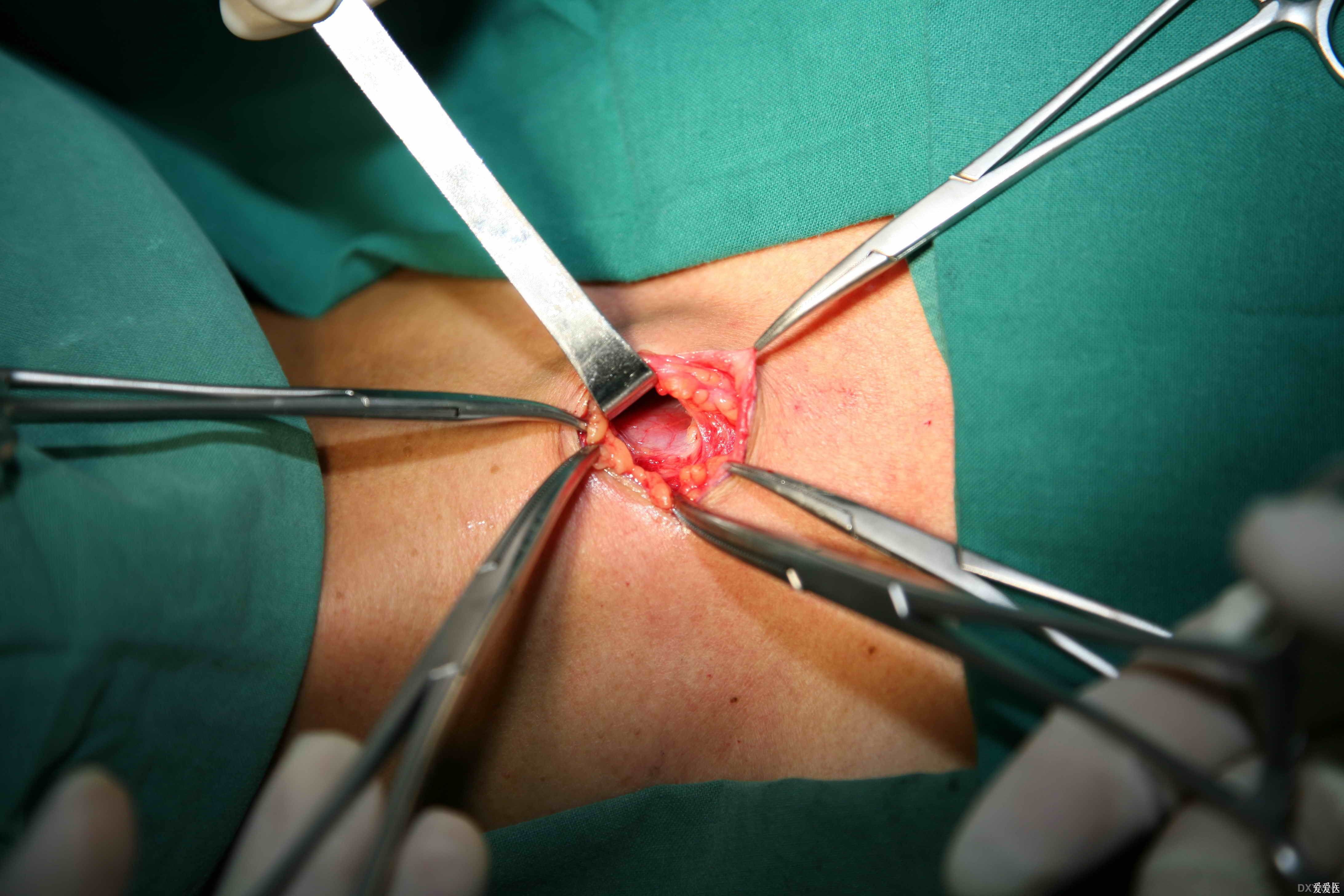 医学动画：气管切开术