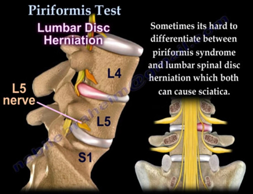 梨状肌试验，梨状肌综合征