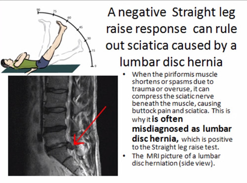 梨状肌综合征的PNF非侵入性治疗