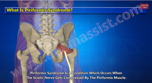 梨状肌综合征是什么，知道它的症状、诊断、治疗