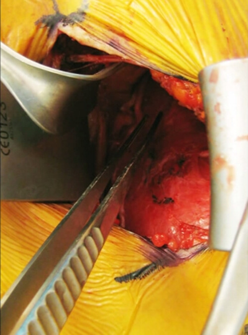 胸长神经受损的外科手术