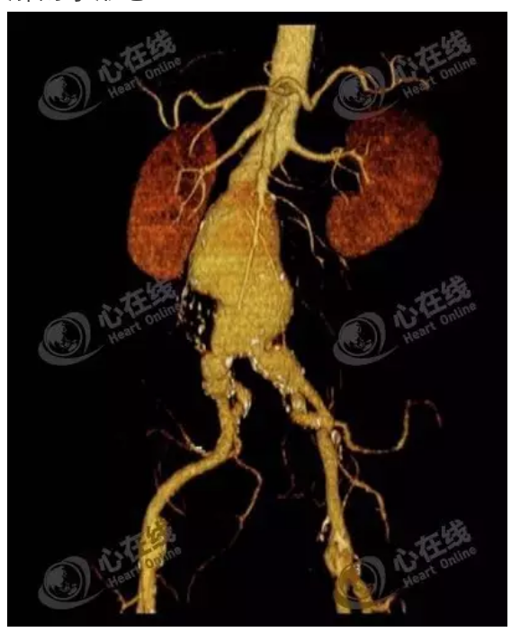 腹主动脉瘤的诊疗及术后康复