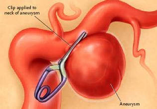 医学动画：颅内动脉瘤夹闭搭桥手术