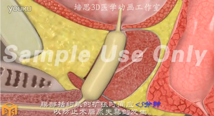 医学动画-尿道扩开术（治疗前列腺增生肥大）