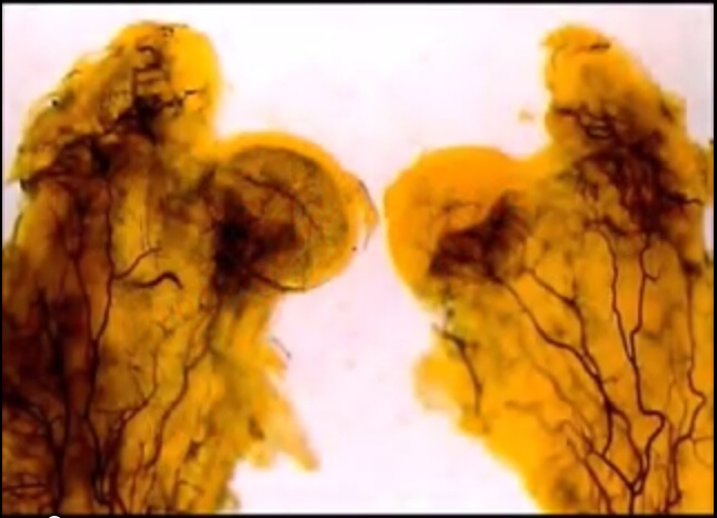 预防和早期治疗股骨头骨骺骨软骨病