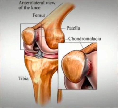 髌骨软化症治疗