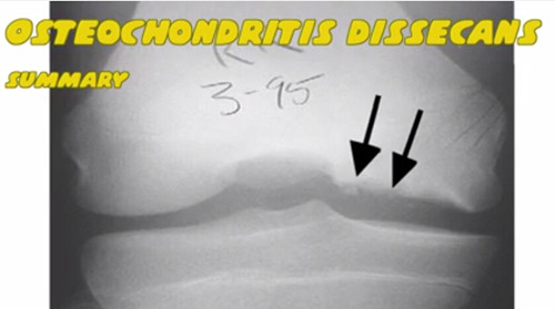 剥脱性骨软骨炎