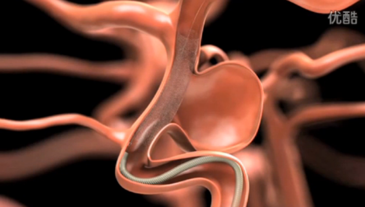 医学动画：治疗复杂性脑动脉瘤