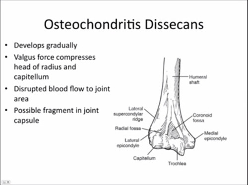 剥脱性骨软骨炎ppt