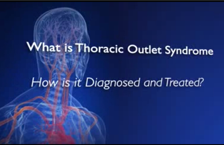 胸廓出口综合征