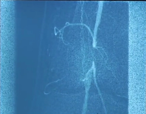 粥样斑块切除术治疗周围血管损伤