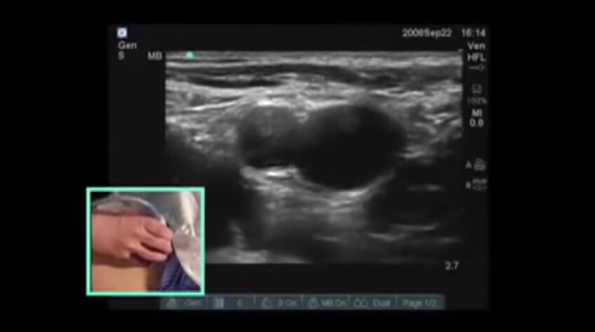 超声波观察下肢深静脉血栓形成