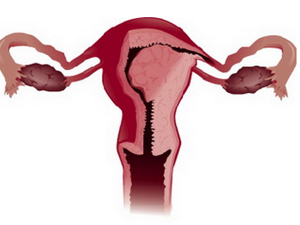 子宫内膜异位症都有哪些类型？