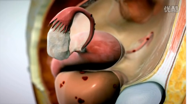 【医学动画】介绍子宫内膜异位症治疗