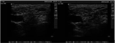 超声引导锁骨上神经阻滞