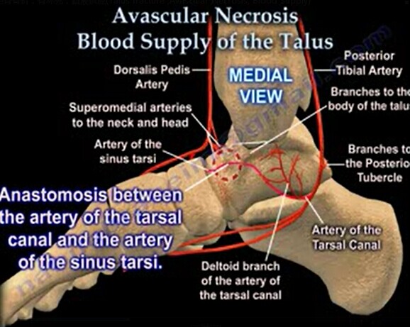 距骨骨折，骨坏死，血液供应