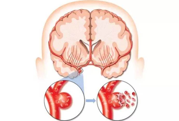 脑中风患者如何合理选择中成药治疗？