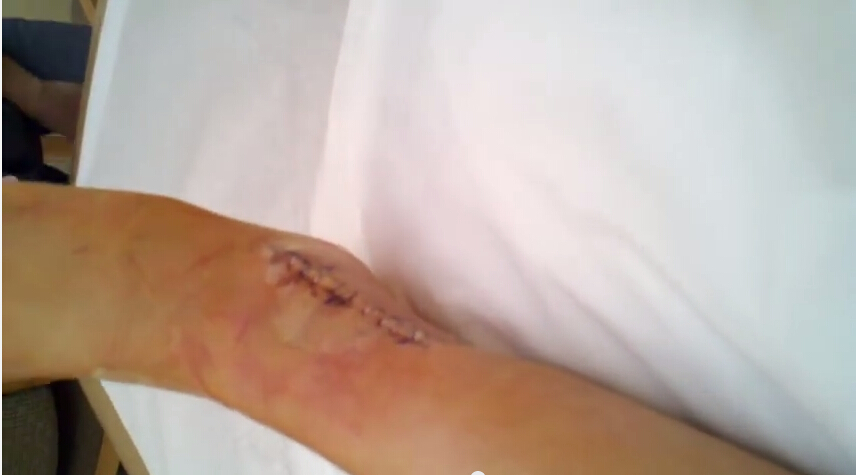 三踝骨折术后1日