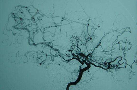 出现哪些症状应高度警惕烟雾病？