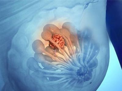 乳腺癌手术