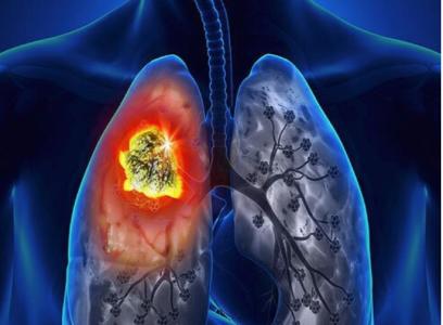 【医学动画】了解肺癌的早期症状