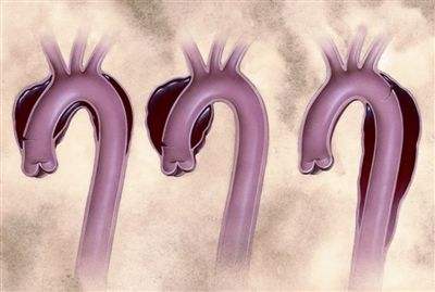 【医学动画】主动脉夹层与动脉瘤