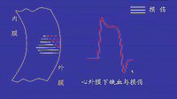 临床心电图学8-1-心肌梗死(一)