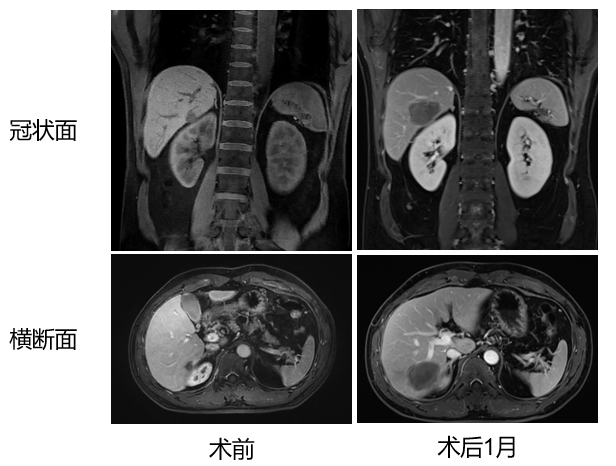 免疫新例量 | 单枪匹马,替雷利珠单抗辅助治疗肝内胆管癌患者,RFS已达9个月